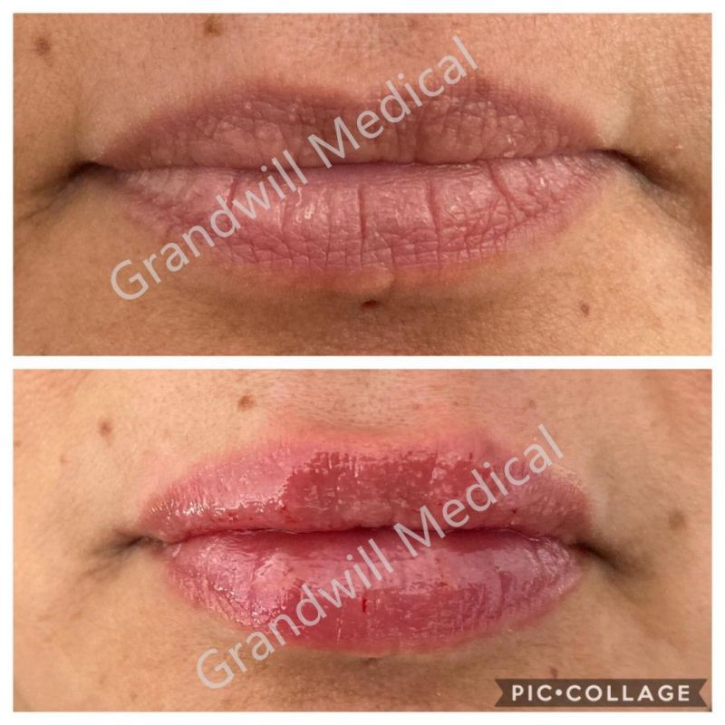 Facial Cross Linked Hyaluronic Acid Dermal Filler for Crow′s Feet