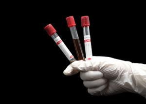 China Factory OEM Disposable Prp Tube Vacuum Blood Collection Tube with Serum separator Gel