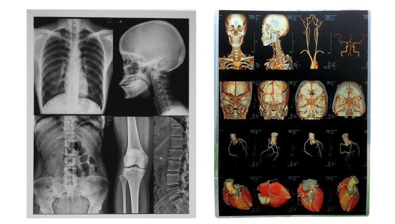 8X10 Inch and 14X17 Inch Medical X-ray Dry Laser Film