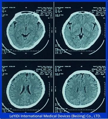 Hospital Medical Dry Imaging Film 8X10 in 20X25 Cm