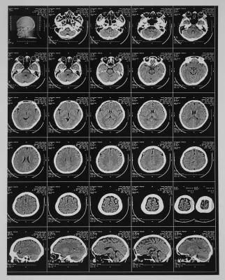 Medical X-ray Laser Films 14X17 / 35X43