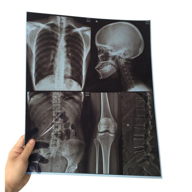 Dry Print Thermal Blue X-ray Film 14 "X 17" for Hospital