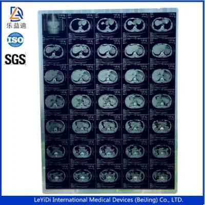 14*17 Inch Inkjet Dry Medical Blue X-ray Film