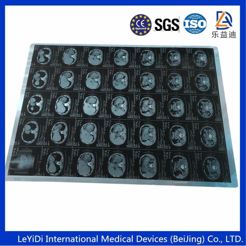 8X10 Inch and 14X17 Inch Medical X-ray Dry Laser Film