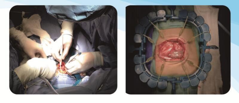 Disposable Lone Star Surgical Retractor Ring