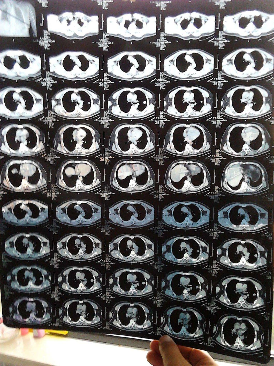 Digitally Printed Medical Dry Film for Direct Thermal Imaging