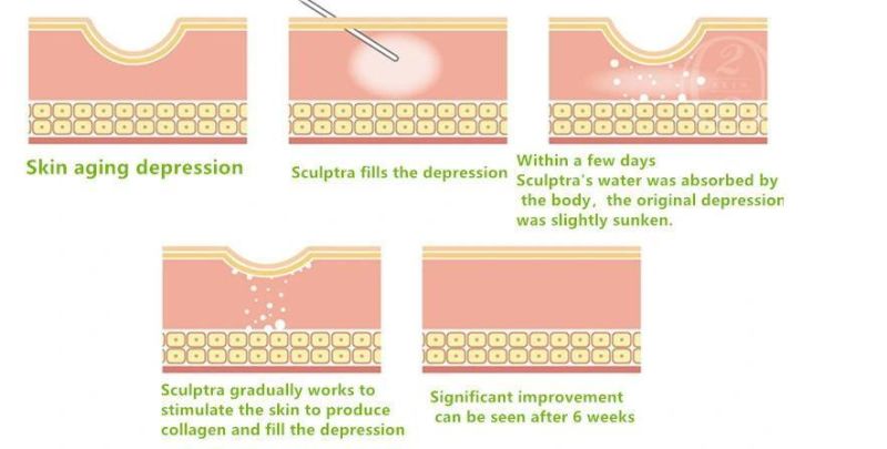 150mg/5ml Wrinkle Removal Butt Injections Hyaluronic Acid Plla Filler for Medical SPA