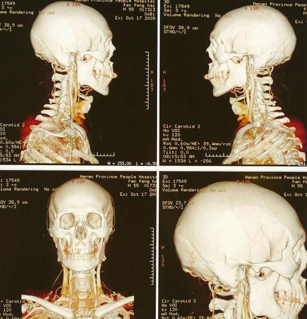 White and Blue Dry Hospital Use Inkjet Medical Film X-ray Film