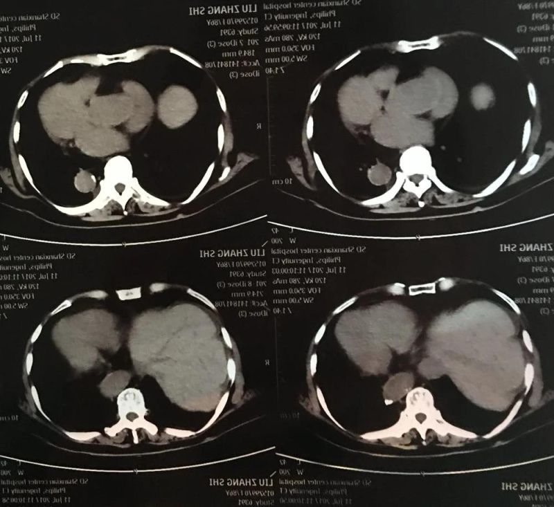 X-ray Medical Dry Film