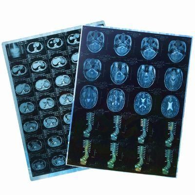 8*10, 10*12, 13*17 Medical X-ray Blue Film, Laser Printing Films