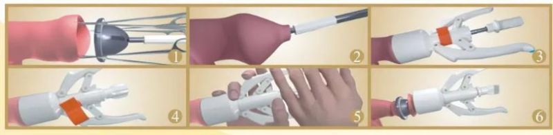 Painless Stitchless Circumcision Device Disposable Zsr Circumcision Foreskin Stapler
