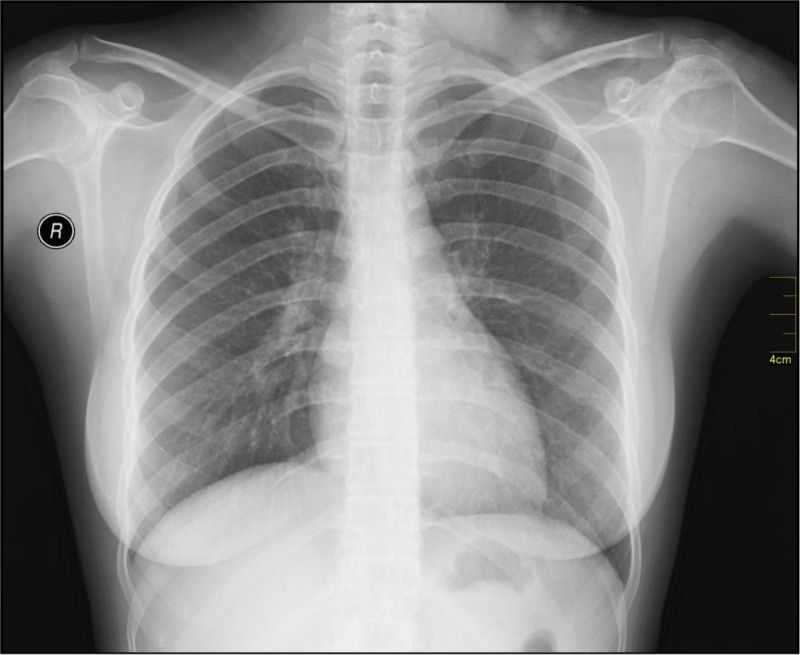 Medical Blue and White Laser X-ray Film