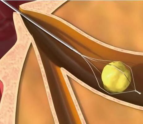 Endoscopic Devices Stone Extraction Basket Disposable with CE ISO FSC