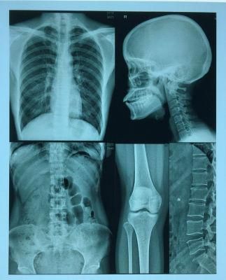 Pet Inkjet Dental X Ray Blue Film for X-ray Dry Medical Imaging CT Dr MRI 11X14 14X17