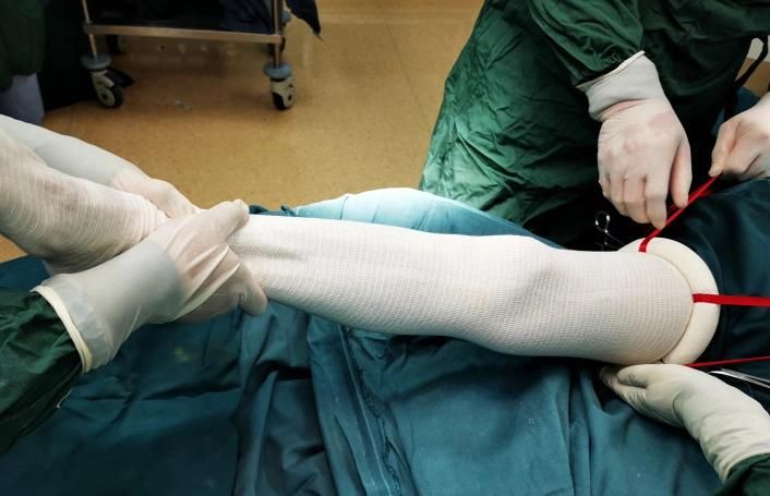 Sterilized Disposable Tourniquet Silicone Ring for Limb Procedures Blood Exsanguination/Occlusion/Removal Safe Orthopedic Surgical Device