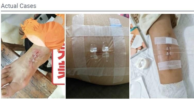 Adhesive Wound Closure Steri Strip Skin Wound Closure
