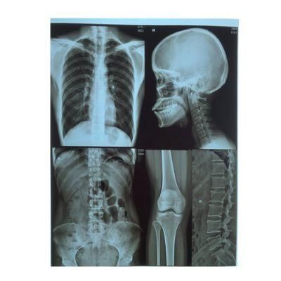 8X10 and 13X17 Inch Medical Dry Inkjet Films for Radiology Department