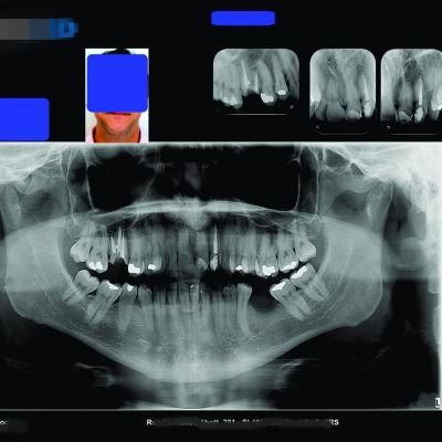 150 Micron A4 and A3 Size White Medical Dry Film for Dental