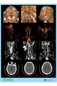 8*10 Inch Universal Laser Radiology Medical Dry Printing Color Hospital Film