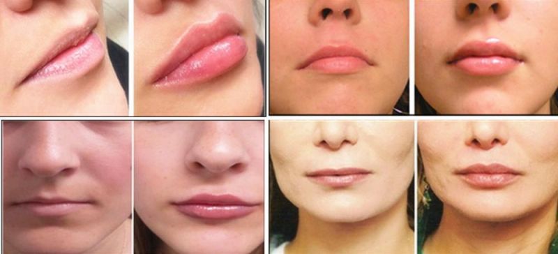 CE 2ml Sunfiller Skin Inject Lip Filler Hyaluronic Acid Injection