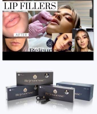 New Rejeunesse Blleast Bllenar Dermal Filler Deep Volume Fine Facial Injections Hyaluronic