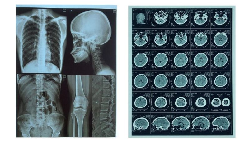 A3 and 13*14 Medical Inkjet Film for X-ray & Ultrasound Blue Color