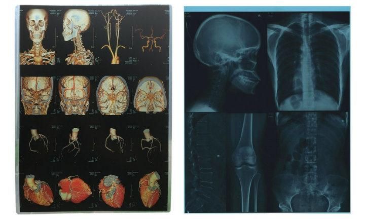10*12 Inch Inkjet Printing White and Blue Medical X-ray Film for Epson & Canon