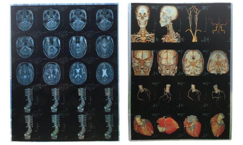 Inkjet Printing Medical Film X-ray Blue