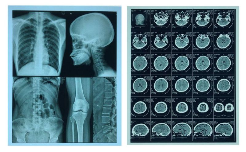 8*10 and 14*17 Inch Blue Thermal X-ray Films
