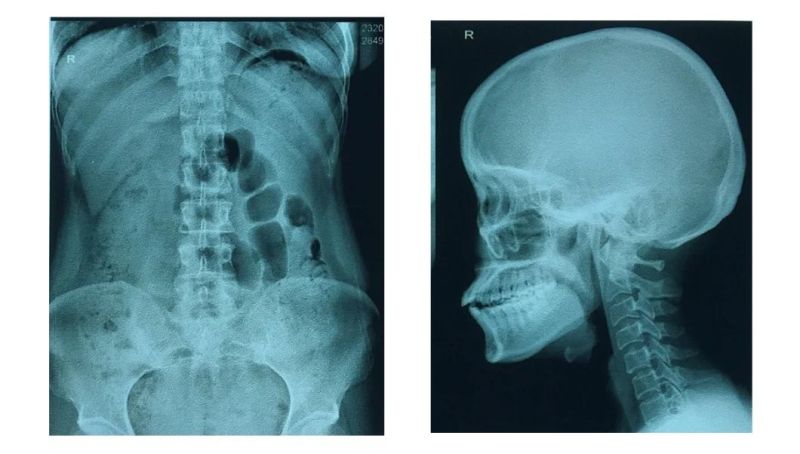 8X10 Inch and 14X17 Inch Medical X-ray Dry Laser Film