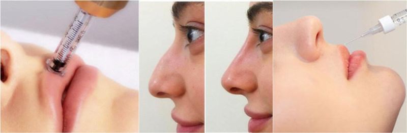 CE Sungel Cosmetic Lip Injection Hyaluronic Acid Dermal Filler for Plastic Surgery