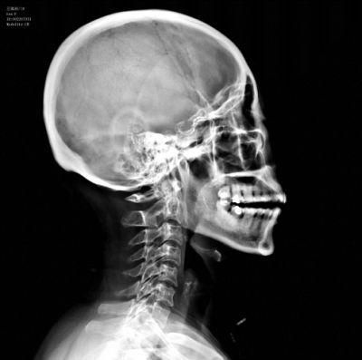 Hospital Radiography Film Medical Dry Film 8X10 Inch