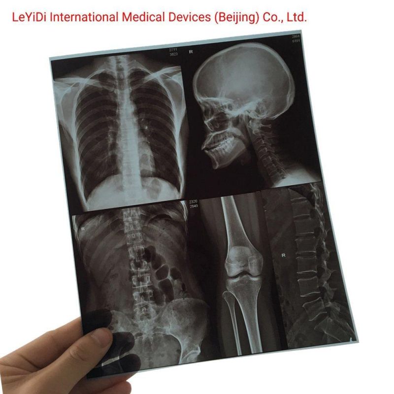 Digital Chest X-ray Films Inkjet Blue Image