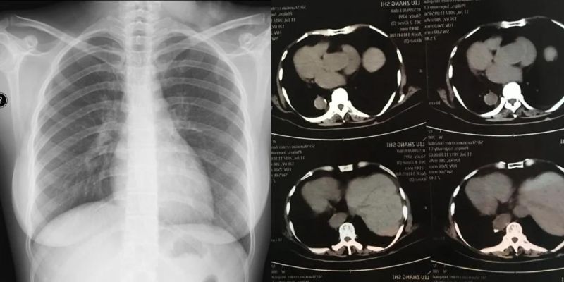 35*43 Cm Laser X-ray Blue Films for Hospital