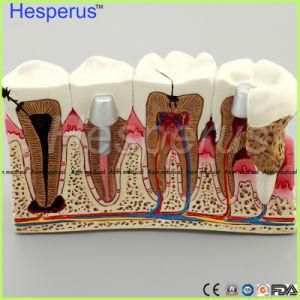 Caries Dental Tooth Model Dentist Patient Communication Anatomy Model