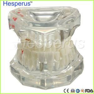 Removable Dental Implant Disease Teaching Teeth Model