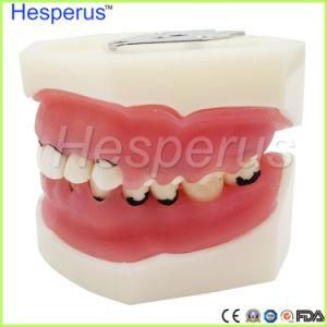 Dental Periodontal Disease Teeth Model / Tooth Medical Model Hesperus